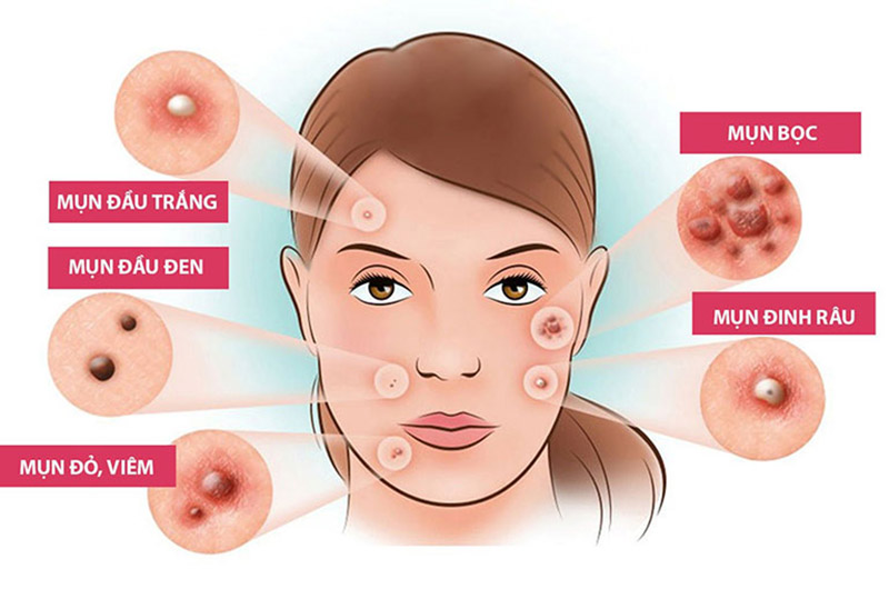 Cách trị mụn cơ bản tại nhà